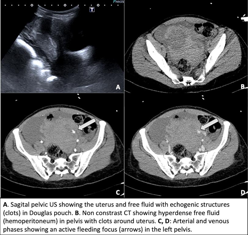 Hemoperitoneum from ruptured heterotopic pregnancy covering ovarian cyst